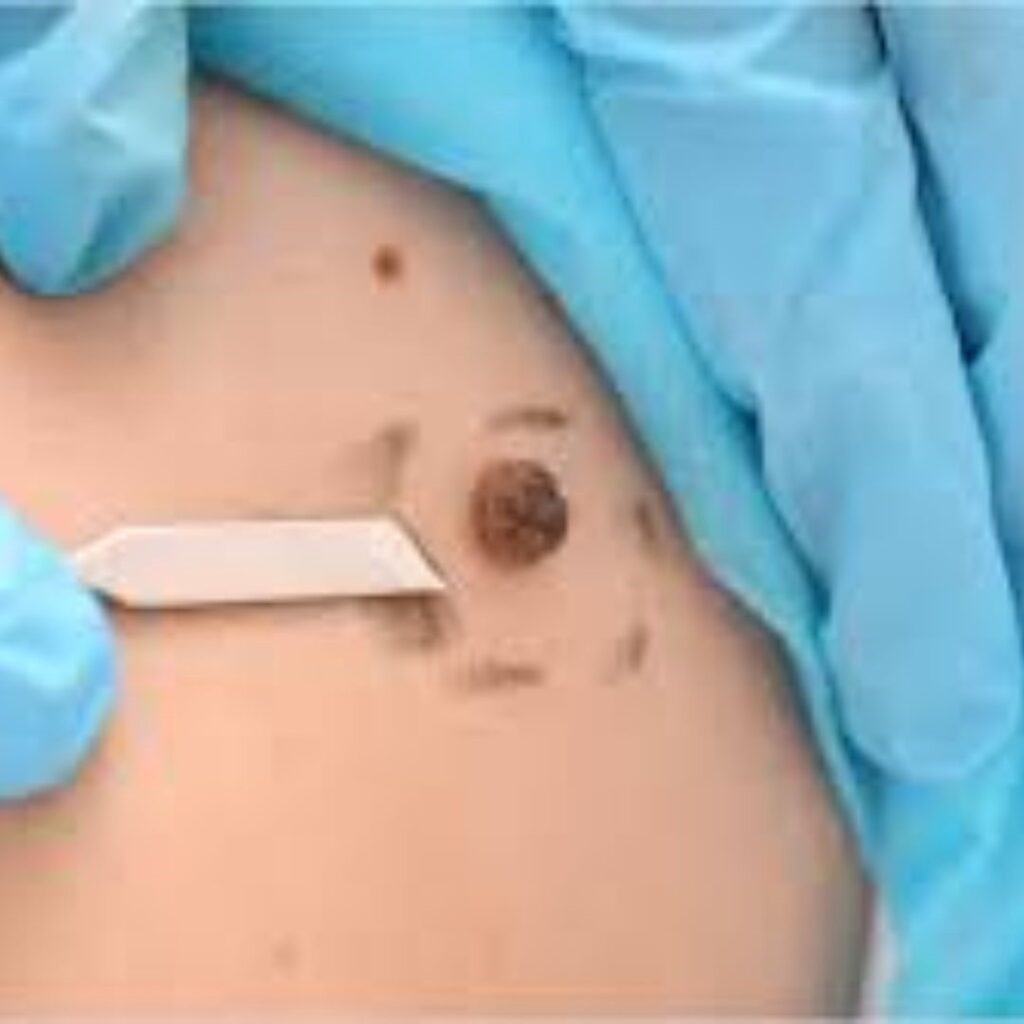 skin tag